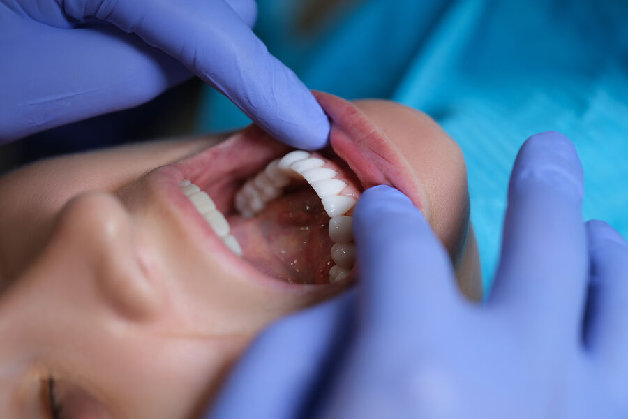 Diş həkimi dişlərdə tünd ləkələrin yaranmasının səbəblərini açıqlayıb
