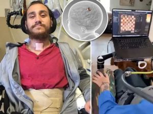image-neuralinks-first-human-noland-arbaugh-78711173-1024x682