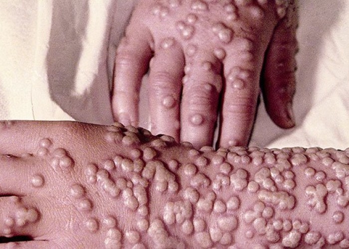 image-1653239007-smallpox-super-722x406